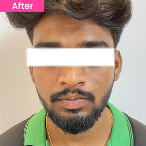 Chemical Peel Treatment After Image